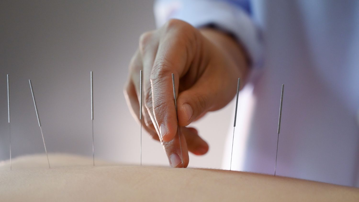 dry needling image